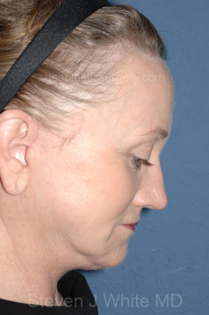Upper & Lower Facelift - Brow Lift & Face/Neck Lift Before & After Patient #8305