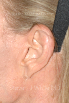 Upper & Lower Facelift - Brow Lift & Face/Neck Lift Before & After Patient #8027