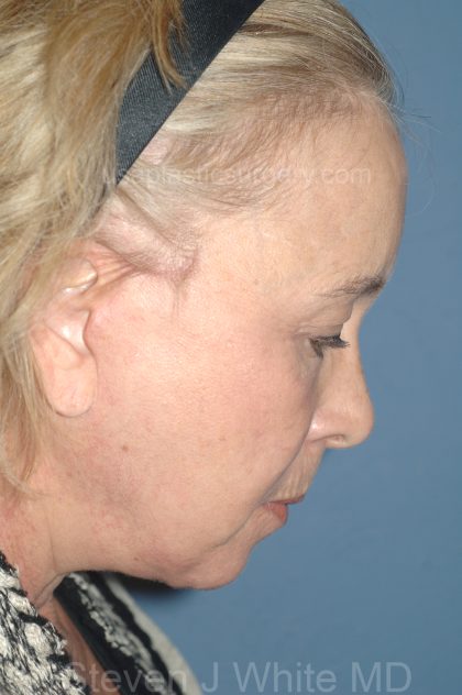 Upper & Lower Facelift - Brow Lift & Face/Neck Lift Before & After Patient #8034