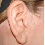 Facelift - Scar Before & After Patient #8175