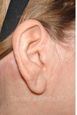 Facelift - Scar Before & After Patient #8175