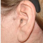 Facelift - Scar Before & After Patient #8175