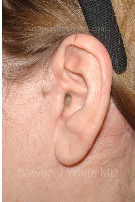 Facelift - Scar Before & After Patient #8175