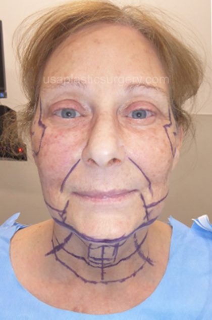 Facelift - Face/Neck (Lower) Before & After Patient #8032