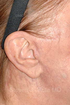 Upper & Lower Facelift - Brow Lift & Face/Neck Lift Before & After Patient #8301