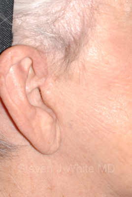Upper & Lower Facelift - Brow Lift & Face/Neck Lift Before & After Patient #8302
