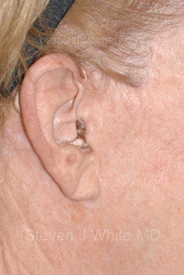 Upper & Lower Facelift - Brow Lift & Face/Neck Lift Before & After Patient #8303