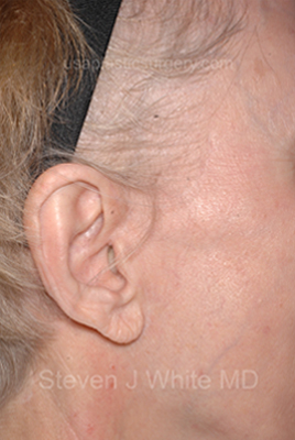 Upper & Lower Facelift - Brow Lift & Face/Neck Lift Before & After Patient #8029