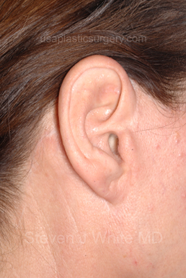 Upper & Lower Facelift - Brow Lift & Face/Neck Lift Before & After Patient #8028