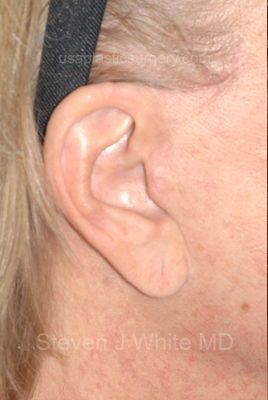 Upper & Lower Facelift - Brow Lift & Face/Neck Lift Before & After Patient #8034