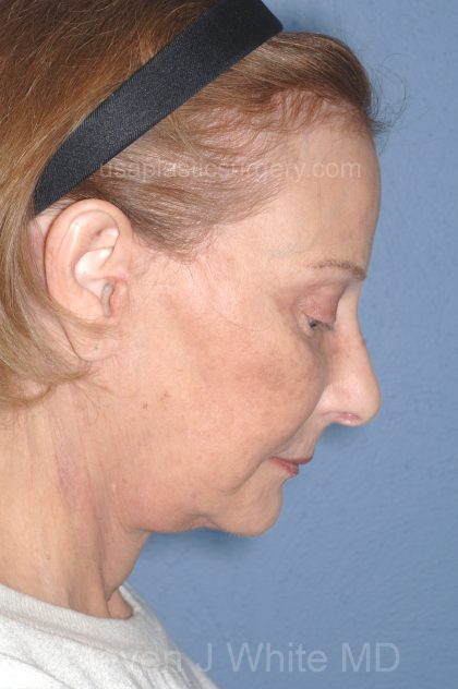 Upper & Lower Facelift - Brow Lift & Face/Neck Lift Before & After Patient #8032