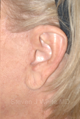 Upper & Lower Facelift - Brow Lift & Face/Neck Lift Before & After Patient #8034