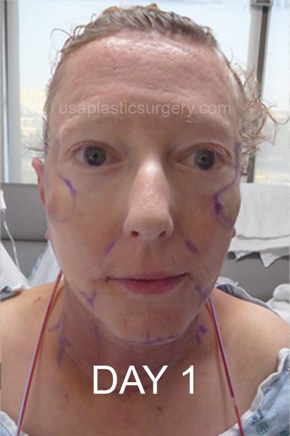 Facelift - Face/Neck (Lower) Before & After Patient #8029