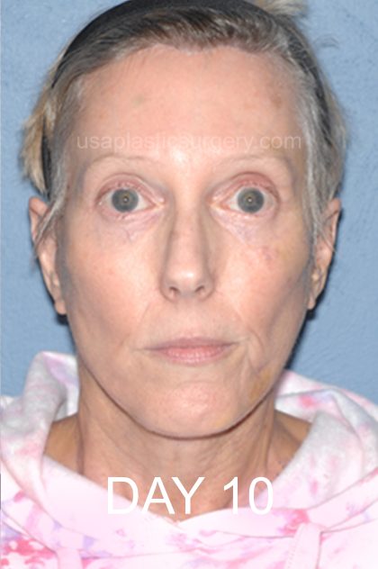Facelift - Face/Neck (Lower) Before & After Patient #8029